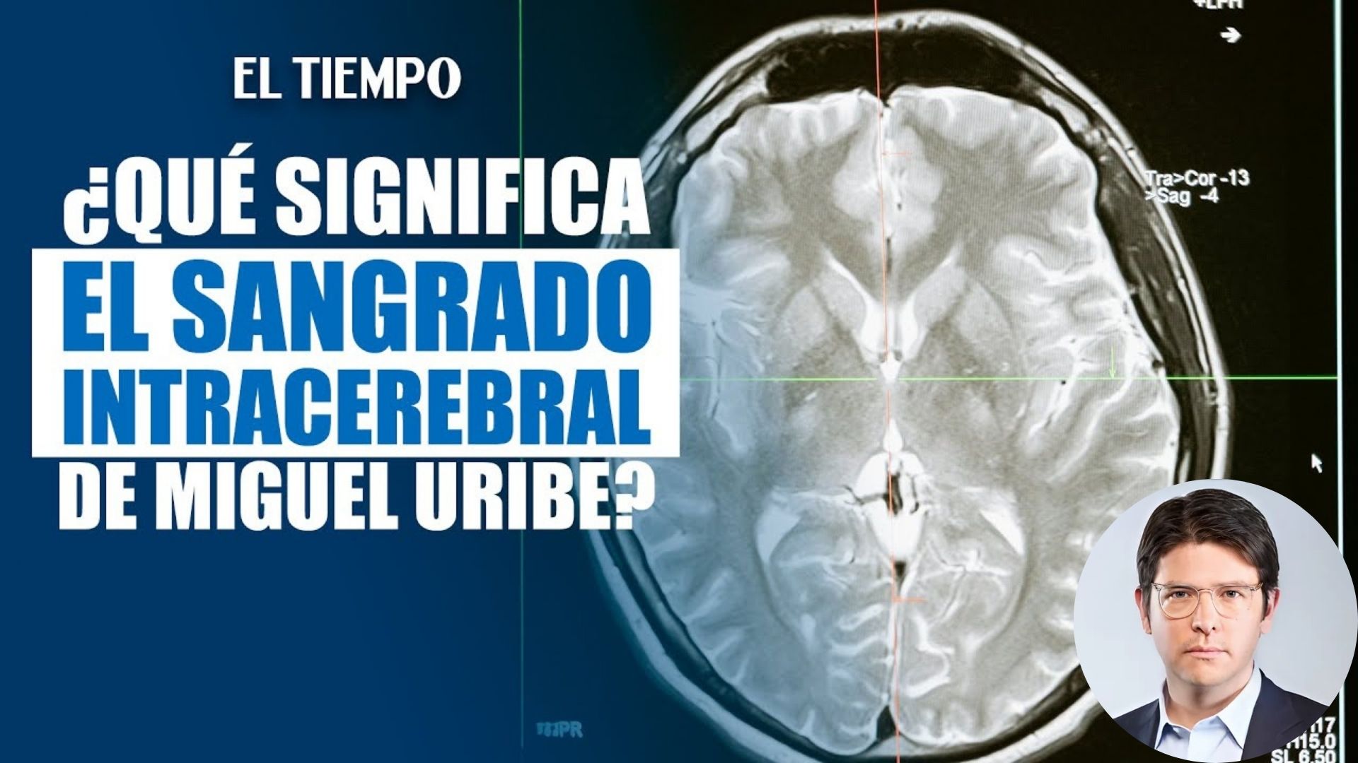 ¿Qué significa ‘sangrado intracerebral agudo’, por lo que operaron de emergencia a Miguel Uribe?